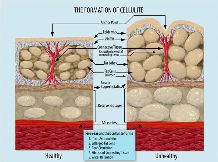getting rid of Cellulite