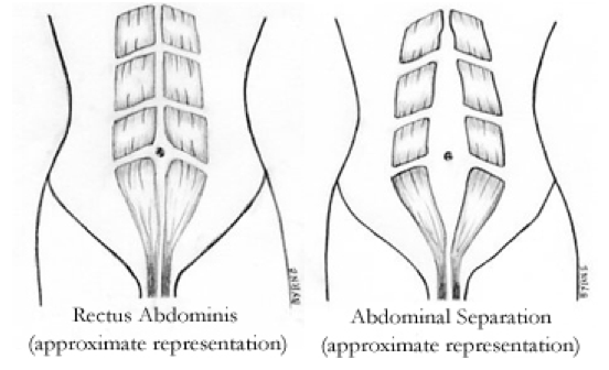 diastasis recti - abdominal separation