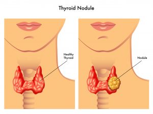 thyroid-questions-and-answers-natalie-jill