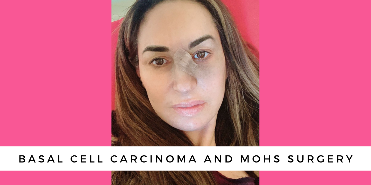 Basal Cell Carcinoma and Mohs Surgery