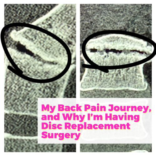 My Back Pain Journey, and Why I’m Having Disc Replacement Surgery