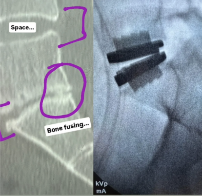 natalie jill l5s1 disc replacement surgery before and after