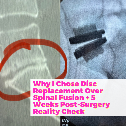Why I Chose Disc Replacement Over Spinal Fusion + 5 Weeks Post-Surgery Reality Check with Dr. Jared Ament