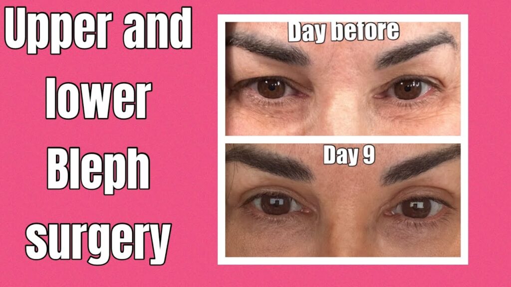 natalie jill bleph surgery before and after